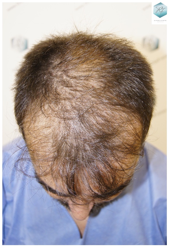 CLINICA DE FREITAS - 3401 + 2829 GRAFTS FUE (TOT, 6230 FUE) 2_zpsfmeo1gek