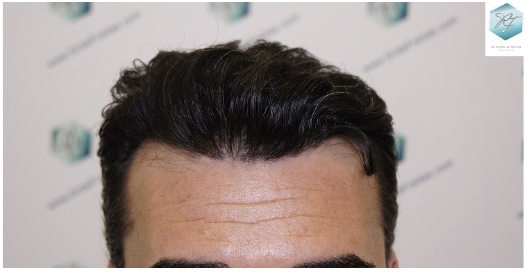 CLINICA DE FREITAS - 3401 + 2829 GRAFTS FUE (TOT, 6230 FUE) 32_zpssvfgyljf