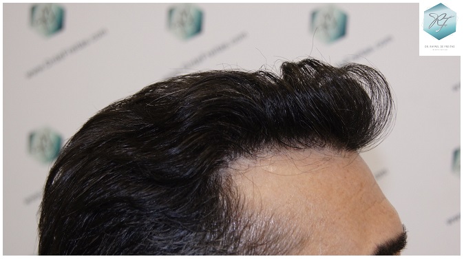 CLINICA DE FREITAS - 3401 + 2829 GRAFTS FUE (TOT, 6230 FUE) 38_zpsjnvds0d4