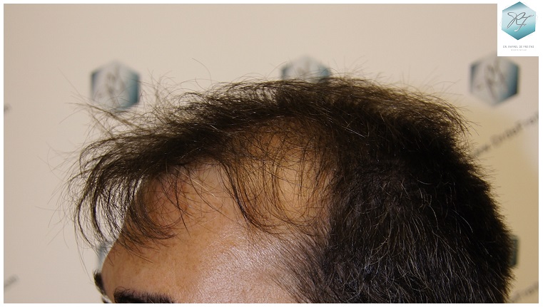 CLINICA DE FREITAS - 3401 + 2829 GRAFTS FUE (TOT, 6230 FUE) 3_zpsfcp2ra1p