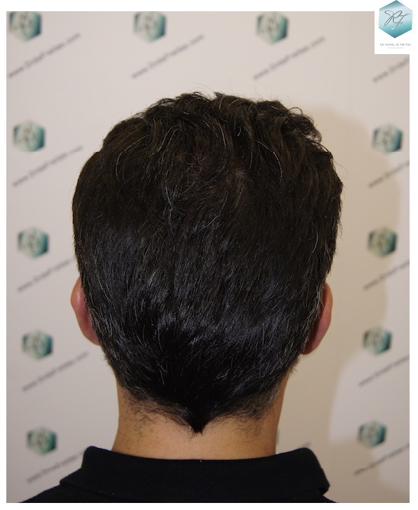 CLINICA DE FREITAS - 3401 + 2829 GRAFTS FUE (TOT, 6230 FUE) 41_zpsit2zlcnd