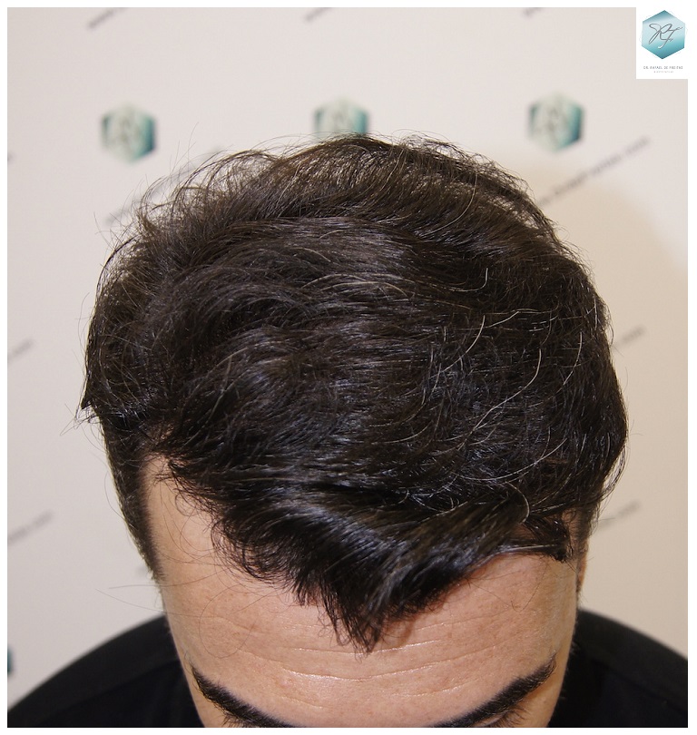 CLINICA DE FREITAS - 3401 + 2829 GRAFTS FUE (TOT, 6230 FUE) 43_zps08hrwfeu