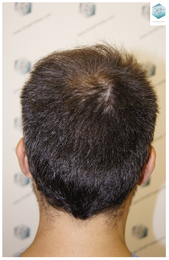 CLINICA DE FREITAS - 3401 + 2829 GRAFTS FUE (TOT, 6230 FUE) 5_zpsfp7man8r