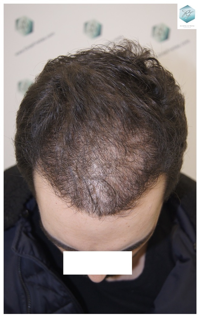 CLINICA DE FREITAS - 3681 GRAFTS FUE 30_zpsu7x7uj4i