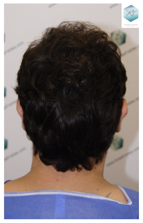 CLINICA DE FREITAS - 3681 GRAFTS FUE 8_zps44x4f7fn