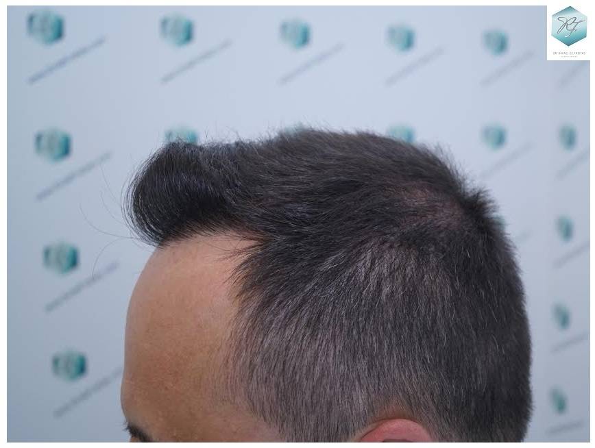 CLINICA DE FREITAS - 2355 + 1815 GRAFTS FUE 42_zpsxme0wvxj