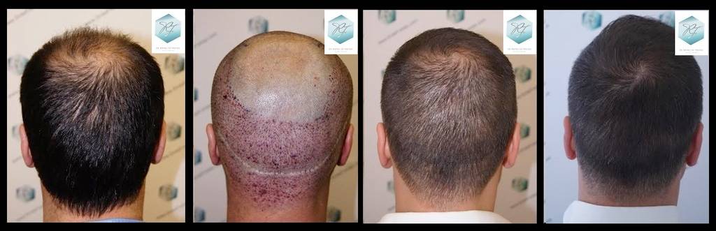 CLINICA DE FREITAS - 2355 + 1815 GRAFTS FUE 56_zpsuvlp522e