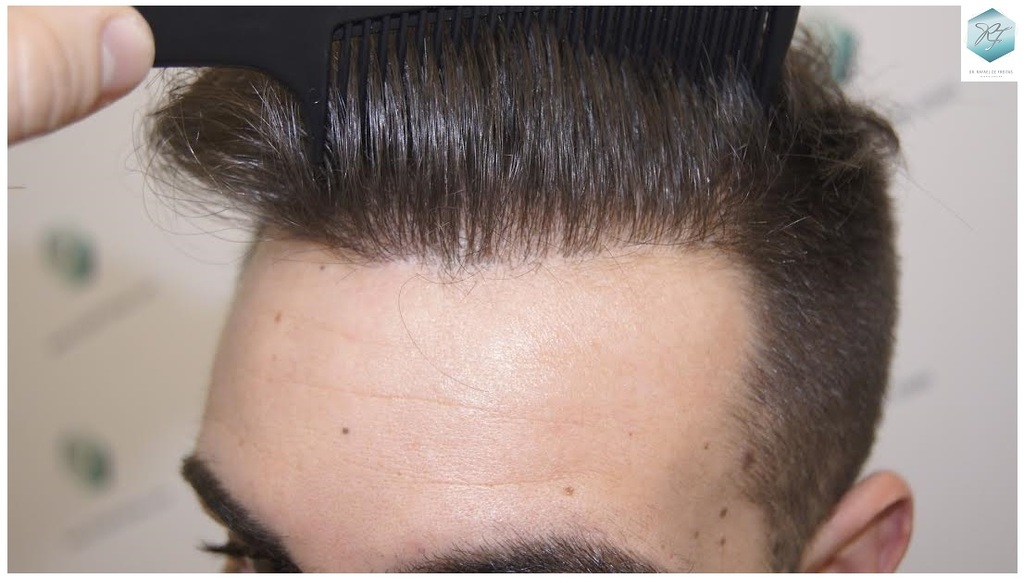 CLINICA DE FREITAS - 3228 + 2184 GRAFTS FUE (TOT. 5412 FUE) 32_zpsf60cc3hc