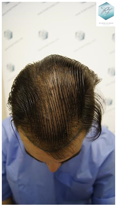 CLINICA DE FREITAS - 3228 + 2184 GRAFTS FUE (TOT. 5412 FUE) 7_zpssauyqoo7