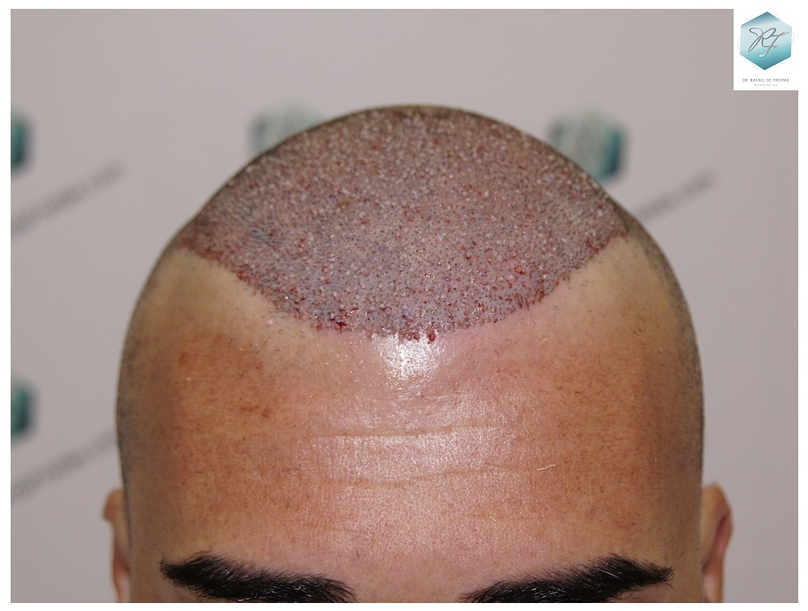 CLINICA DE FREITAS - 3401 + 2829 GRAFTS FUE (TOT, 6230 FUE) 31_zps0yujhyoa