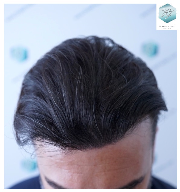 CLINICA DE FREITAS - 3401 + 2829 GRAFTS FUE (TOT, 6230 FUE) 40_zpsbperw36g