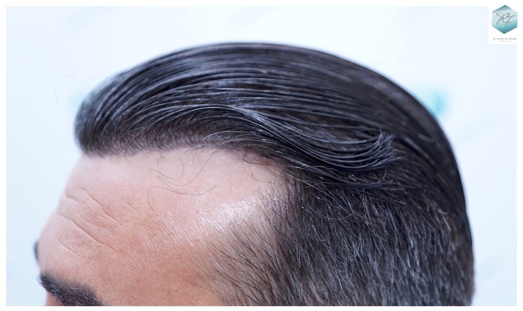 CLINICA DE FREITAS - 3401 + 2829 GRAFTS FUE (TOT, 6230 FUE) 51_zpsgx4ptx9y