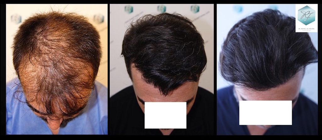 CLINICA DE FREITAS - 3401 + 2829 GRAFTS FUE (TOT, 6230 FUE) Fondo%20negro%204_zpswpvjuhkm