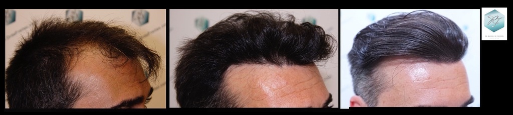 CLINICA DE FREITAS - 3401 + 2829 GRAFTS FUE (TOT, 6230 FUE) Fondo%20negro%205_zpsidddnxzg