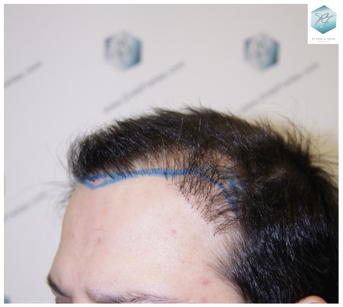 CLINICA DE FREITAS - 1792 + 1609 GRAFTS FUE (REPAIR) 14_zpsxgpfy9wt