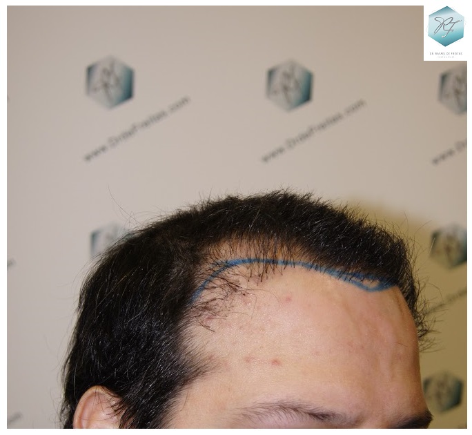 CLINICA DE FREITAS - 1792 + 1609 GRAFTS FUE (REPAIR) 15_zpshanviuyn