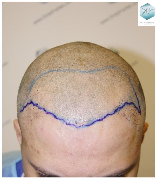 CLINICA DE FREITAS - 1792 + 1609 GRAFTS FUE (REPAIR) 17_zpsp5cnkiid