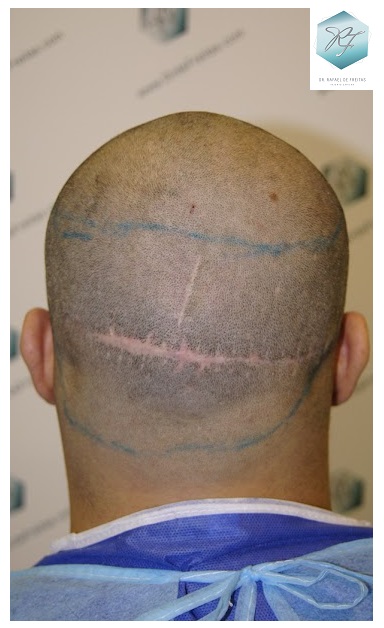 CLINICA DE FREITAS - 1792 + 1609 GRAFTS FUE (REPAIR) 22_zpsrpvv3fog