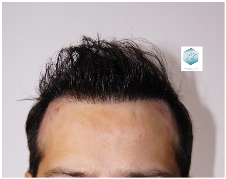 CLINICA DE FREITAS - 1792 + 1609 GRAFTS FUE (REPAIR) 35_zpsbmtn95es