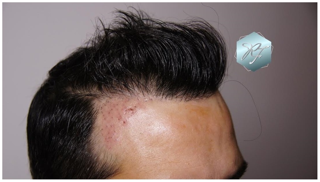 CLINICA DE FREITAS - 1792 + 1609 GRAFTS FUE (REPAIR) 37_zps7meupwfb