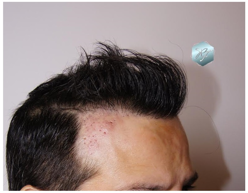 CLINICA DE FREITAS - 1792 + 1609 GRAFTS FUE (REPAIR) 38_zpsjfavrwlm