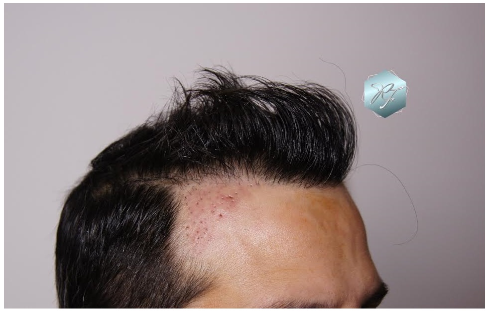 CLINICA DE FREITAS - 1792 + 1609 GRAFTS FUE (REPAIR) 39_zpsox3xqkcy