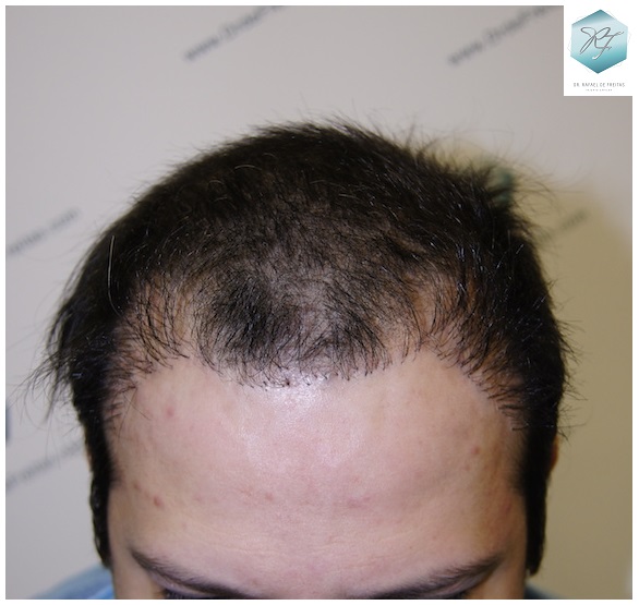 CLINICA DE FREITAS - 1792 + 1609 GRAFTS FUE (REPAIR) 3_zpsshj2zvbn