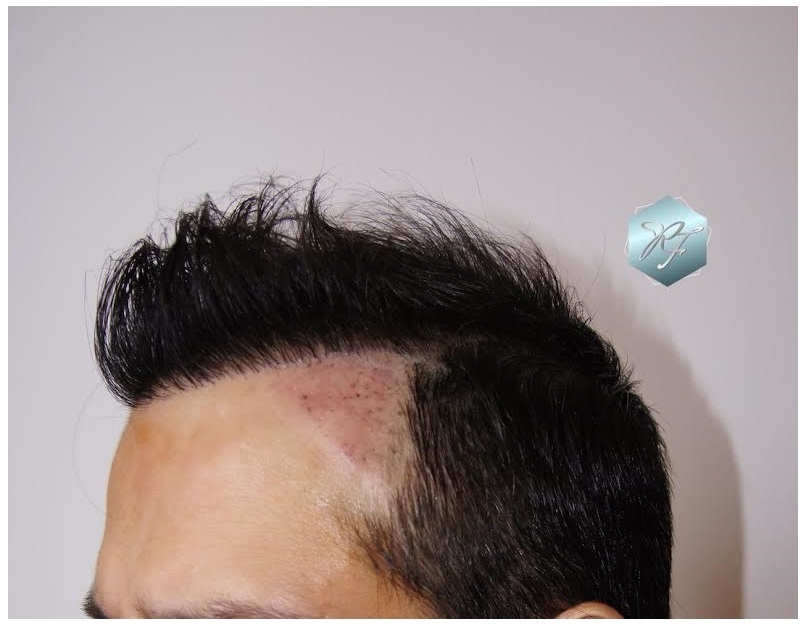 CLINICA DE FREITAS - 1792 + 1609 GRAFTS FUE (REPAIR) 40_zpsupkpohdx