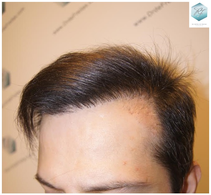 CLINICA DE FREITAS - 1792 + 1609 GRAFTS FUE (REPAIR) 41_zpsnyb9blwi