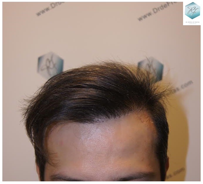 CLINICA DE FREITAS - 1792 + 1609 GRAFTS FUE (REPAIR) 46_zps4qc6z0gn