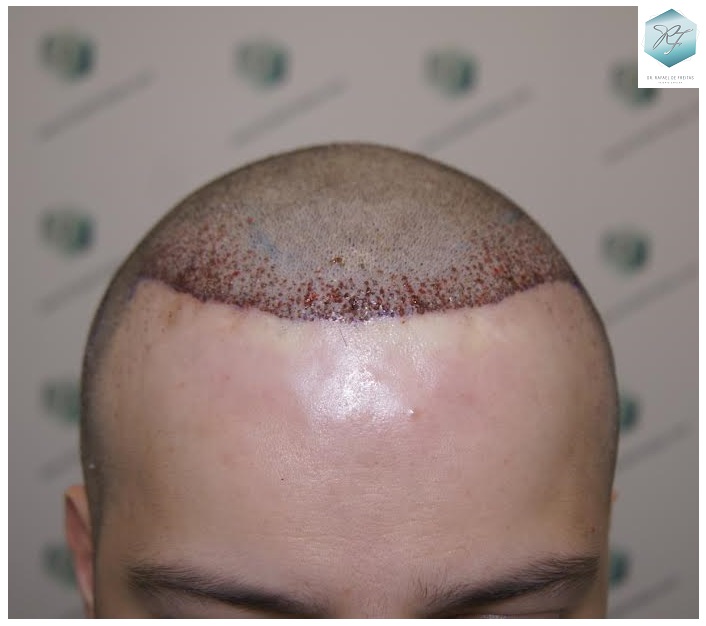 CLINICA DE FREITAS - 1792 + 1609 GRAFTS FUE (REPAIR) 49_zpsixr7ukto