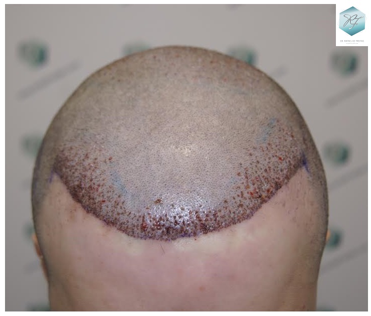 CLINICA DE FREITAS - 1792 + 1609 GRAFTS FUE (REPAIR) 50_zpst1gbqaoj