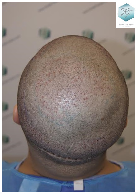 CLINICA DE FREITAS - 1792 + 1609 GRAFTS FUE (REPAIR) 54_zpsf0ki9bp0