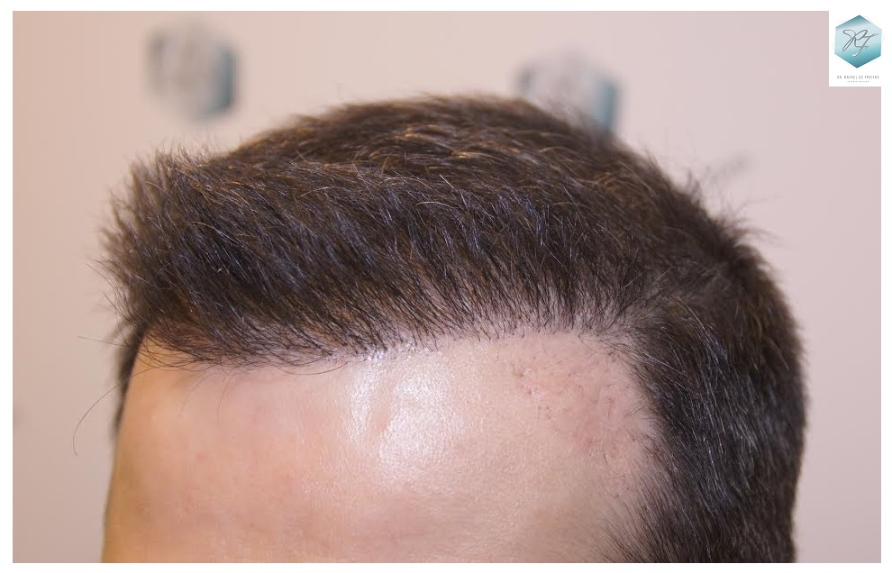 CLINICA DE FREITAS - 1792 + 1609 GRAFTS FUE (REPAIR) 58_zpsvsabzix7