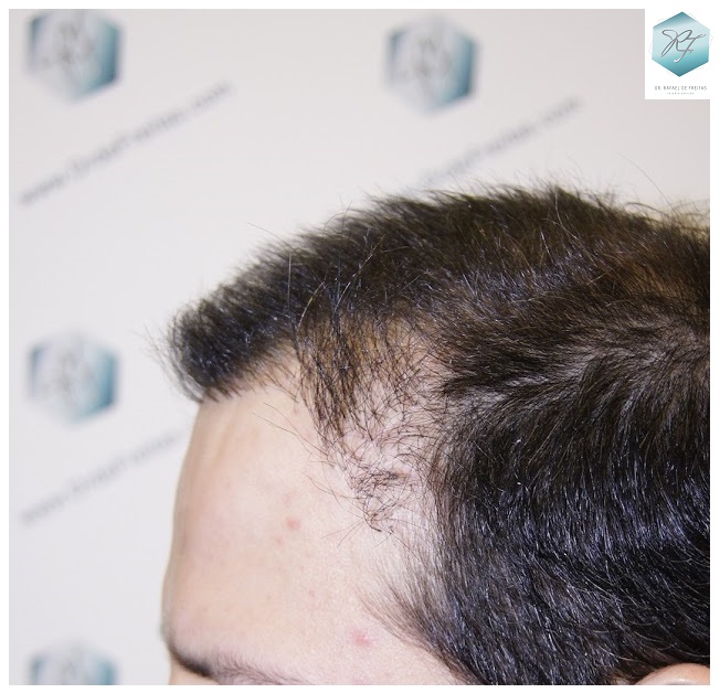 CLINICA DE FREITAS - 1792 + 1609 GRAFTS FUE (REPAIR) 5_zpszxmt9cma