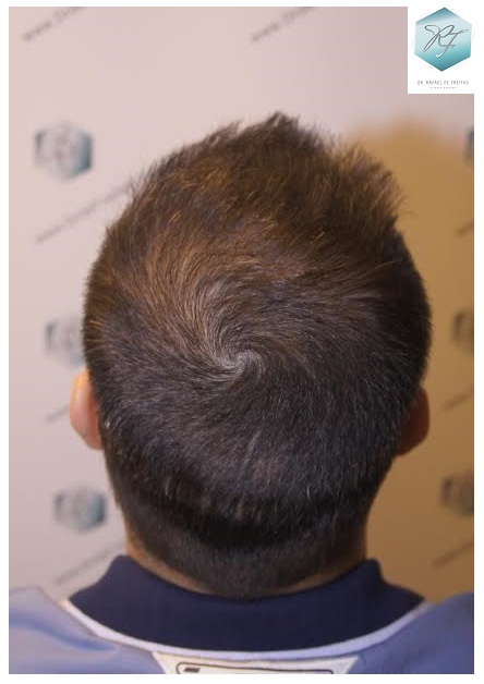 CLINICA DE FREITAS - 1792 + 1609 GRAFTS FUE (REPAIR) 61_zpscdtuvwi0