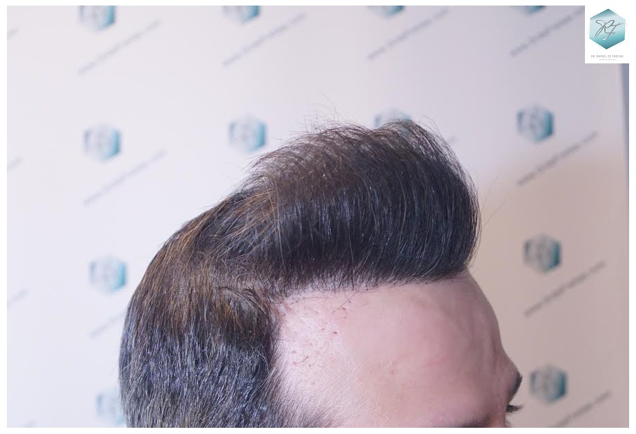 CLINICA DE FREITAS - 1792 + 1609 GRAFTS FUE (REPAIR) 67_zpsvm24op30