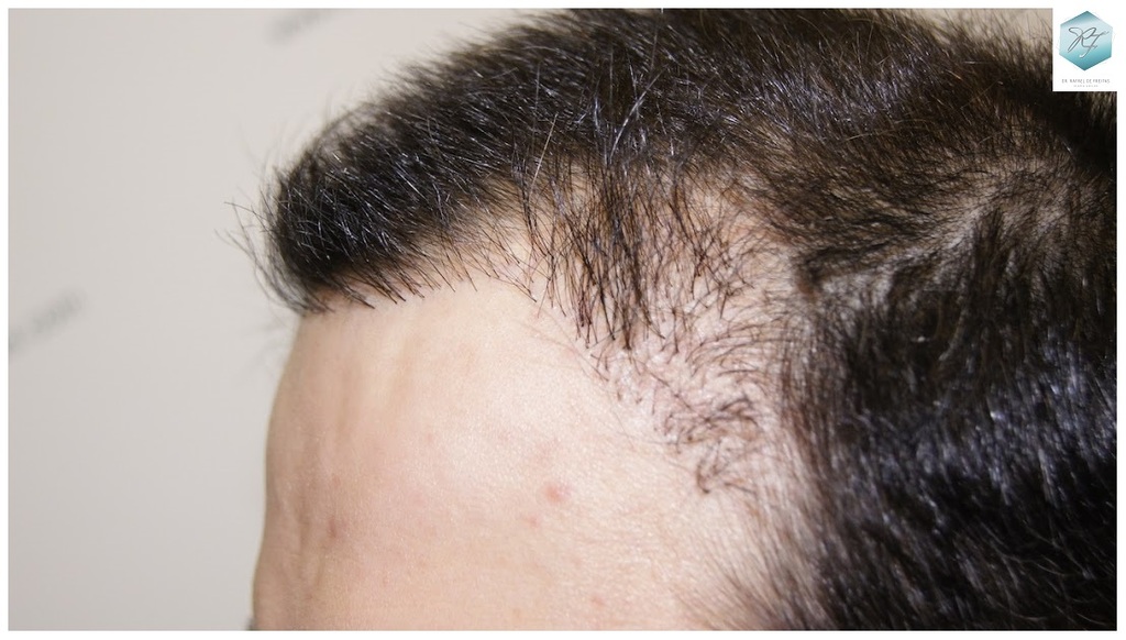 CLINICA DE FREITAS - 1792 + 1609 GRAFTS FUE (REPAIR) 6_zpsi98ca2j9