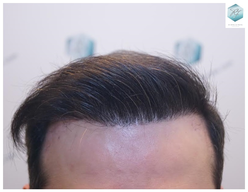 CLINICA DE FREITAS - 1792 + 1609 GRAFTS FUE (REPAIR) 74_zpsu2chgf21