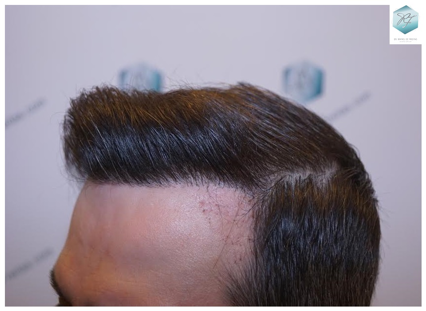 CLINICA DE FREITAS - 1792 + 1609 GRAFTS FUE (REPAIR) 75_zpsvknmujwc