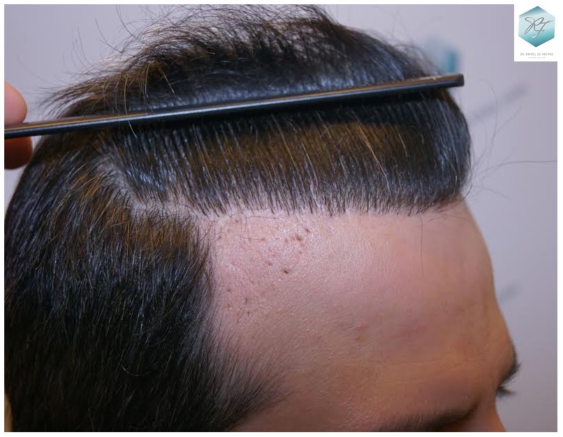 CLINICA DE FREITAS - 1792 + 1609 GRAFTS FUE (REPAIR) 76_zps0vt2d8v1