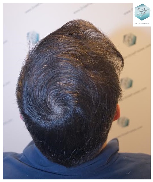 CLINICA DE FREITAS - 1792 + 1609 GRAFTS FUE (REPAIR) 80_zpsumlc37th