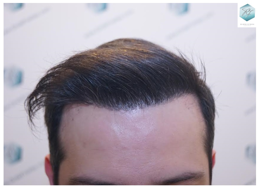 CLINICA DE FREITAS - 1792 + 1609 GRAFTS FUE (REPAIR) 81_zps5xlhl8ud