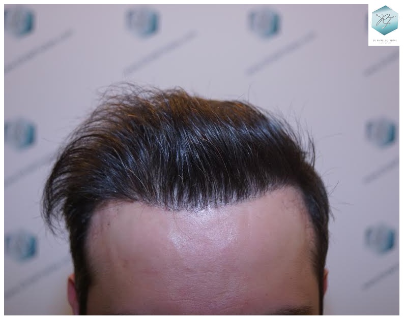 CLINICA DE FREITAS - 1792 + 1609 GRAFTS FUE (REPAIR) 82_zpslrfvc3j1