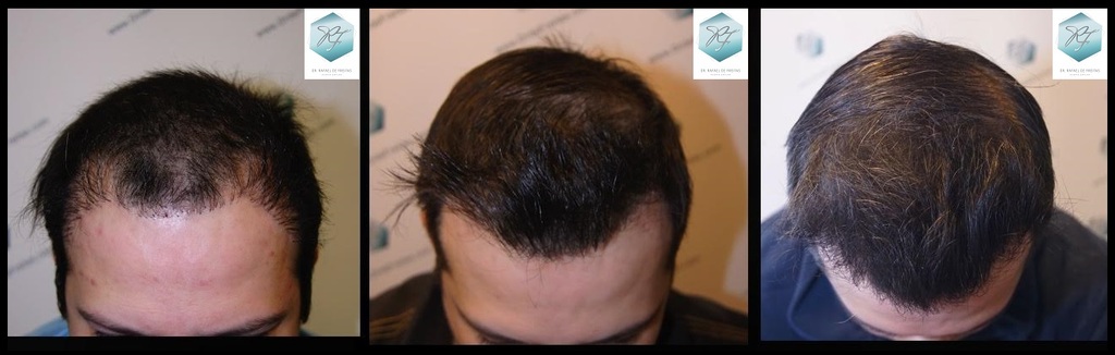 CLINICA DE FREITAS - 1792 + 1609 GRAFTS FUE (REPAIR) 85_zpsgmflh5wp