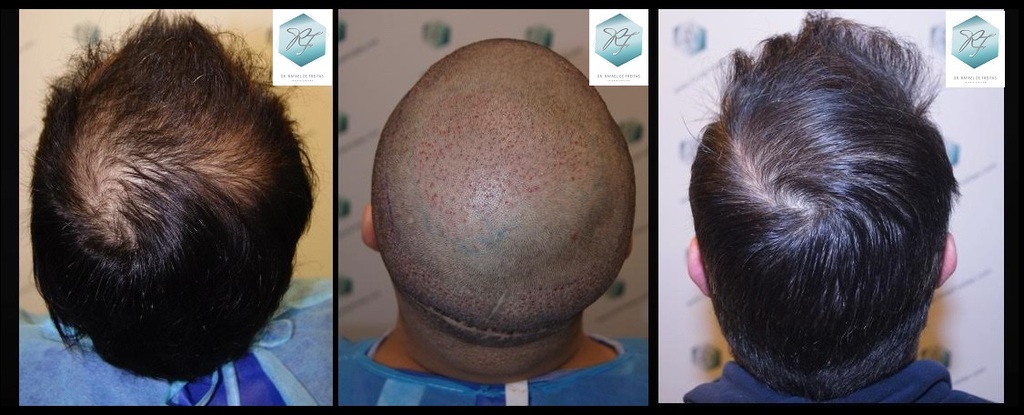 CLINICA DE FREITAS - 1792 + 1609 GRAFTS FUE (REPAIR) 89_zps25l8itl6