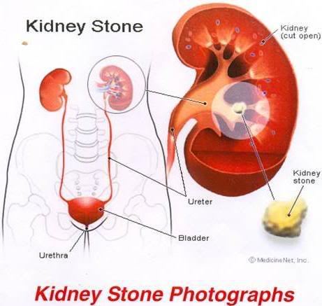 சிறுநீரக கல் - எளிய மருத்துவம் Kidney_stone_photographs