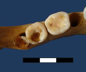 La caries de los homínidos de Atapuerca Caries