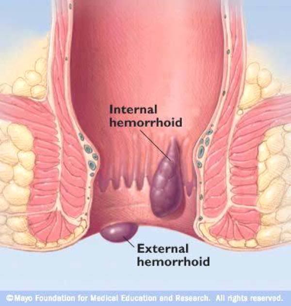 الشرخ الشرجي R7_hemorrhoids