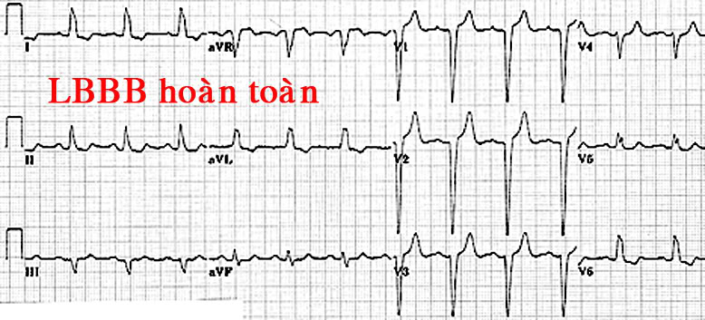 ĐIỆN TÂM ĐỒ – Chủ đề 3: RL dẫn truyền trong thất LBBB3